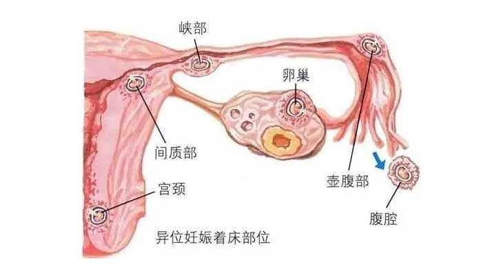 鹤岗49岁供卵试管的成功率_胚胎着床位置会影响试管婴儿成功率，三亚姐妹是真